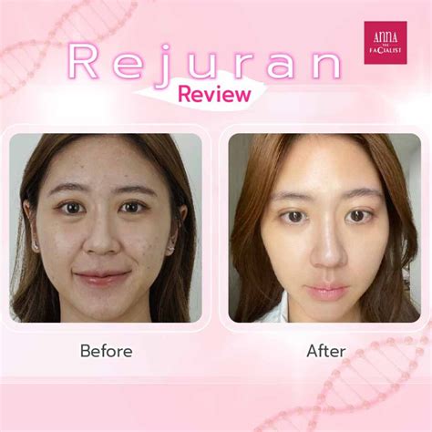 Chanel injection vs Rejuran Reviews.